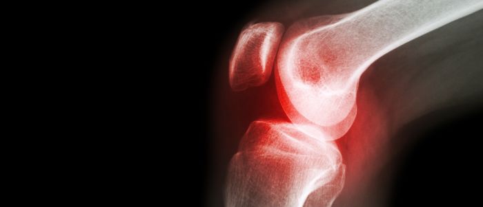Krakende knieën kunnen op artritis wijzen