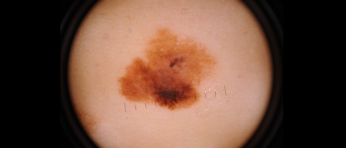 melanoom - huidkanker