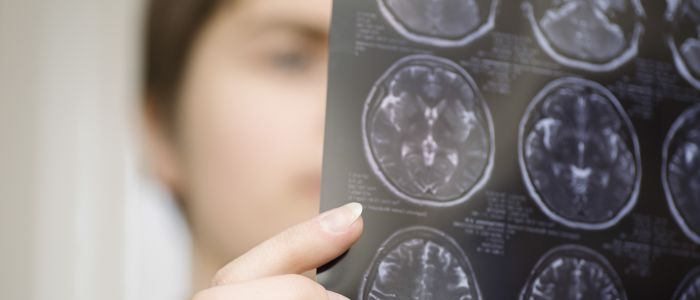 verminderd hersenvolume - epilepsie | Mijn Gezondheidsgids