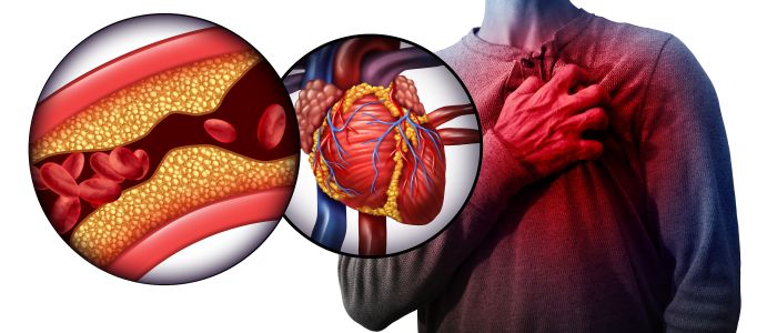 Wat is het verschil tussen een hartinfarct en een hartstilstand?